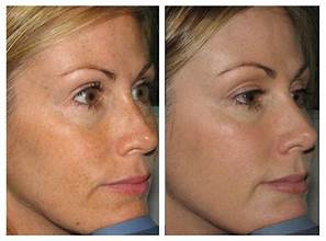 Laser Hair Removal