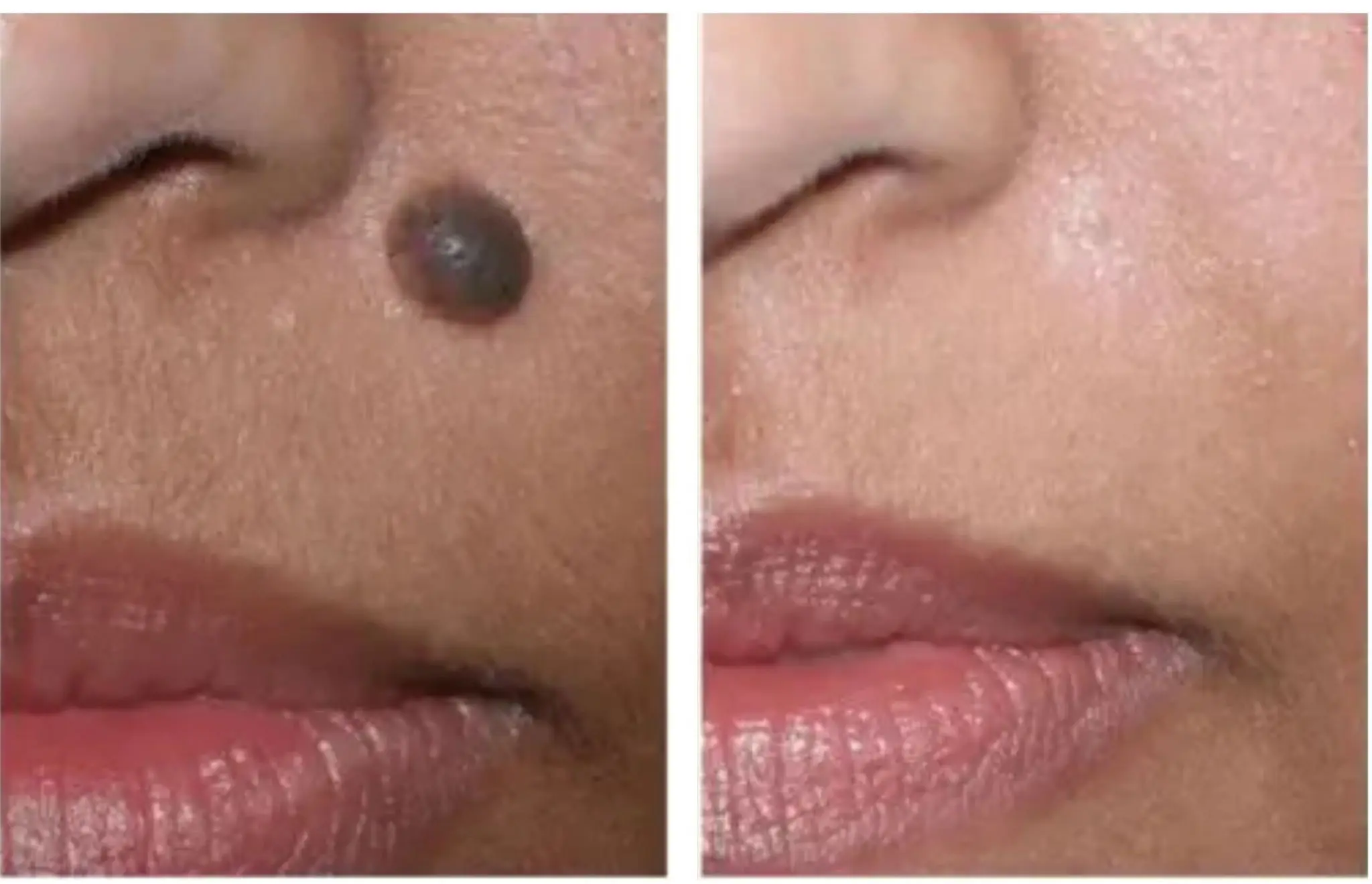 Mole Removal
