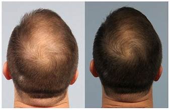 PRP Therapy